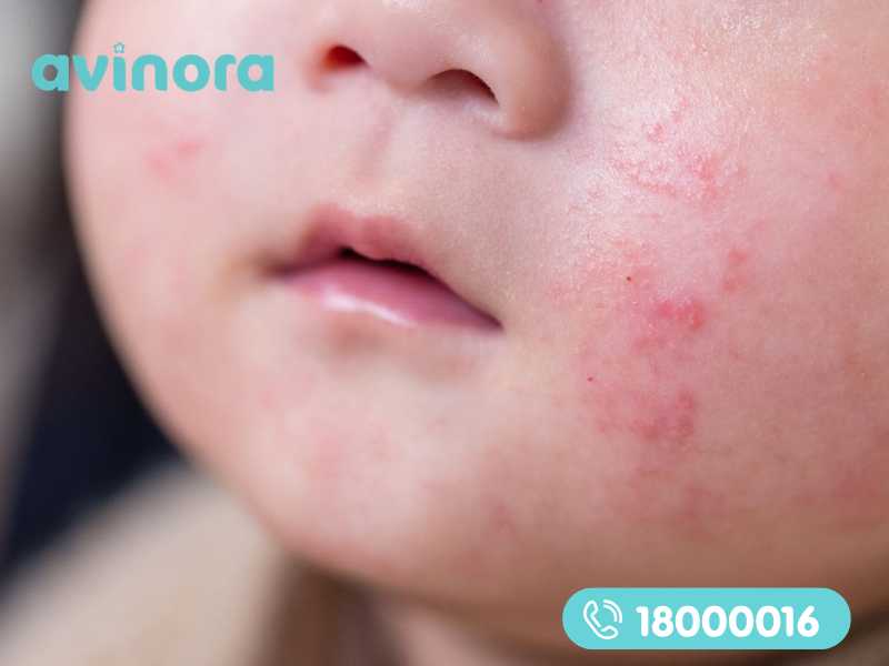Da trẻ bị khô kích ứng có thể do sữa tắm không phù hợp