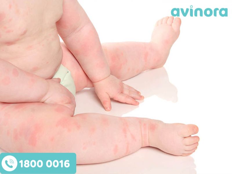 Sulfate có thể làm suy yếu hàng rào bảo vệ da