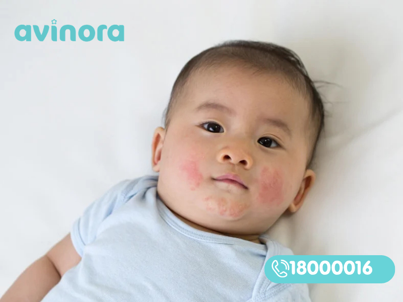 Em bé bị chàm sữa